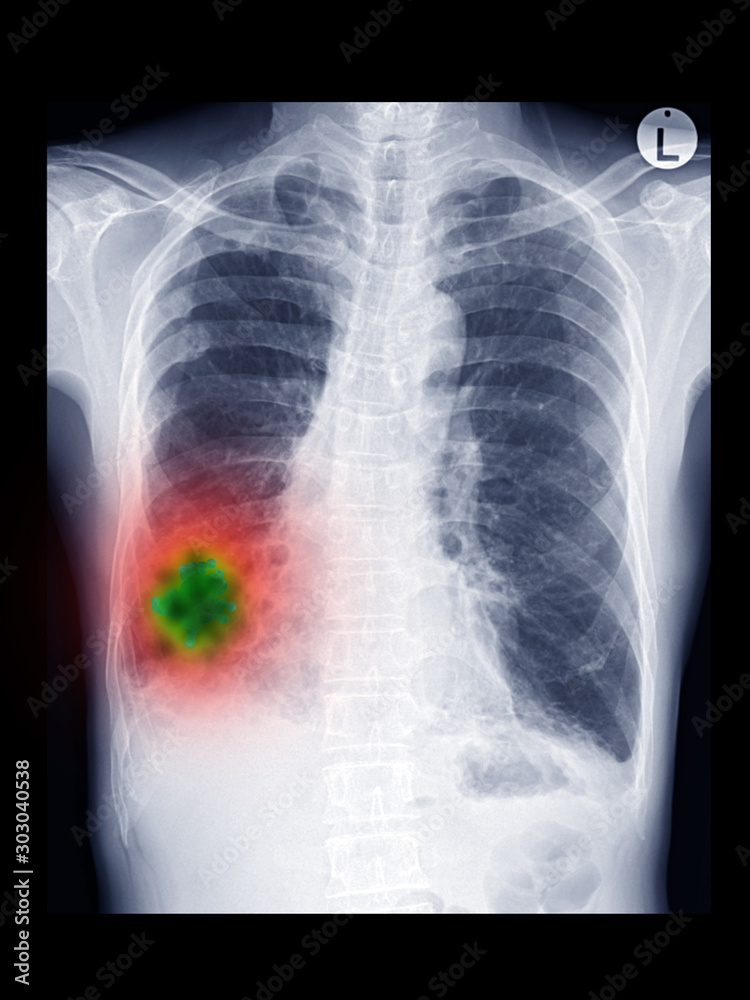 Film x ray chest radiograph show infiltration at right lower lobe. This can cause form pneumonia, pulmonary tuberculosis (TB), fungal infection, restrictive lung disease, cancer (CA). medical concept Film x ray chest radiograph show infiltration at right lower lobe. This can cause form pneumonia, pulmonary tuberculosis (TB), fungal infection, restrictive lung disease, cancer (CA). medical concept