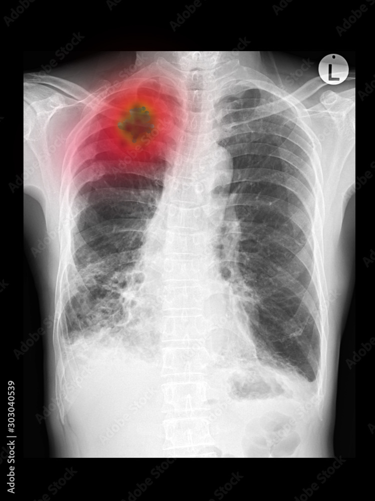 Film x ray chest radiograph (CXR) show infiltration at right upper lobe. This may cause from pneumonia, pulmonary tuberculosis (TB), fungal infection, restrictive lung disease, cancer (CA). Film x ray chest radiograph (CXR) show infiltration at right upper lobe. This may cause from pneumonia, pulmonary tuberculosis (TB), fungal infection, restrictive lung disease, cancer (CA).
