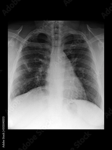 Film x-ray chest radiograph show collapsed lung (atelectasis disease). collapse or closure of lung cause reduced gas exchange and breathing difficult. medical imaging concept.