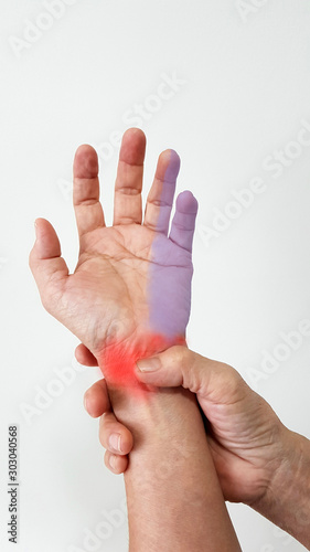 Hand anatomy. The patient suffer from  symptom wrist pain (red highlight), numbness and tingling(blue highlight) from ulnar tunnel syndrome disease(nerve entrapment in Guyon canal). medical problem photo