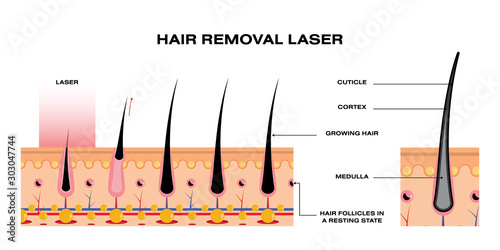 HAIR REMOVAL LASER with diagram science style