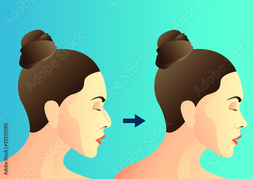 stock vector of nose reduction before and after plastic surgery. side view women face. describe of plastic surgery, surgical cosmetic procedure. for advertising and medical publications.