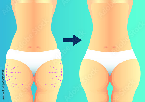 stock vector of buttocks increase before and after plastic surgery. describe of plastic surgery, surgical cosmetic procedure. for advertising and medical publications.