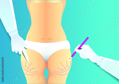 stock vector of hand drawing dotted lines on woman buttocks. describe of plastic surgery, surgical cosmetic procedure. for advertising and medical publications.