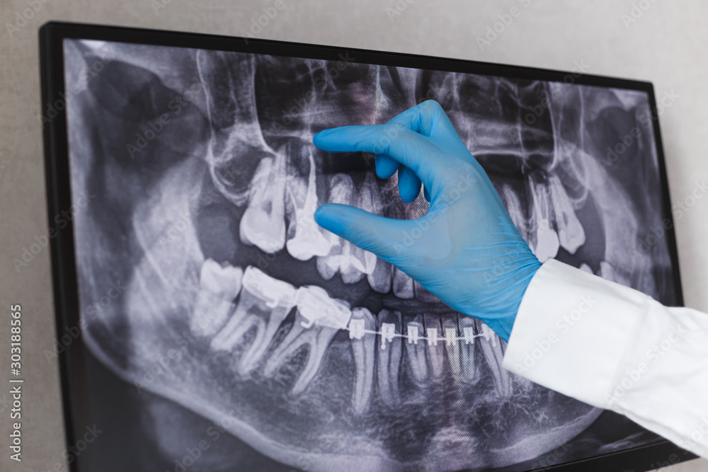 Doctor points to filled root canal in dental x-ray