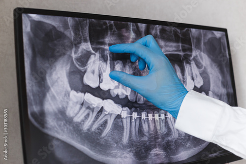 Slika na platnu Doctor points to filled root canal in dental x-ray
