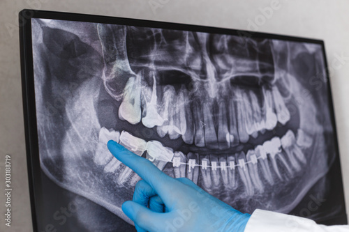 Obraz na płótnie Doctor points wisdom tooth in dental x-ray. w salonie