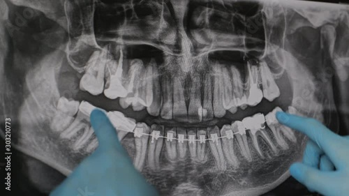 Doctor shows on the monitor a treatment plan on an x-ray of the jaw.