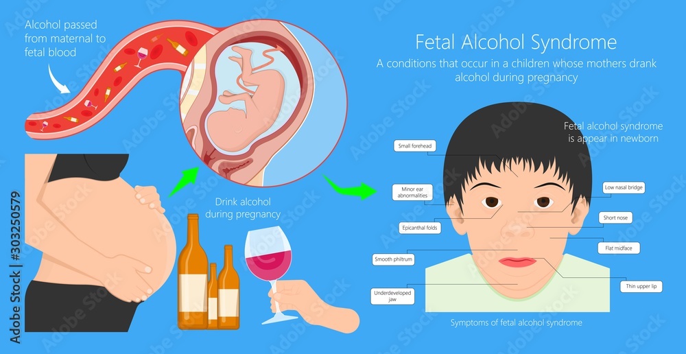 Vetor de Fetal alcohol spectrum syndrome disorders conditions mother