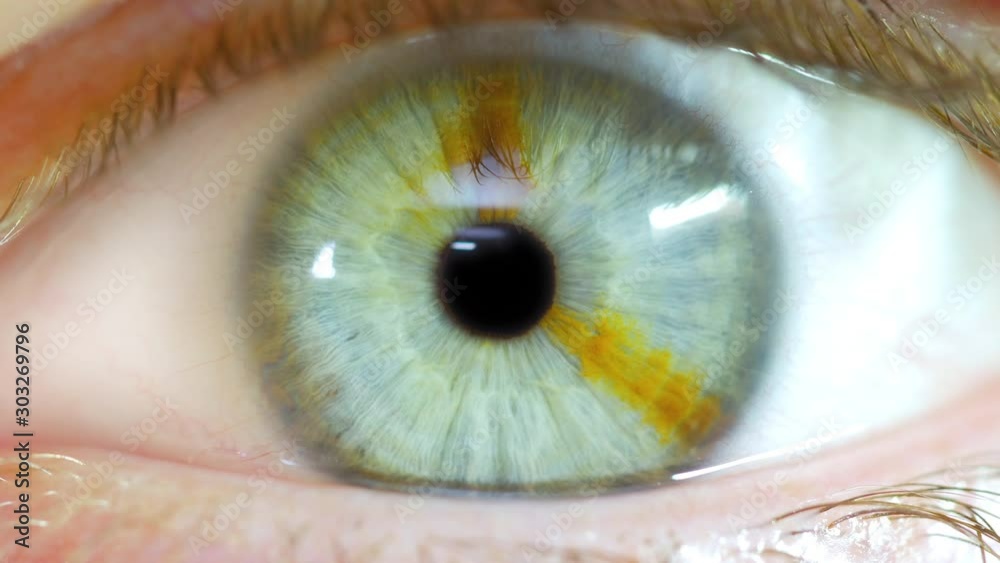 Male opening eye to reveal pupil with brown birthmark in iris 