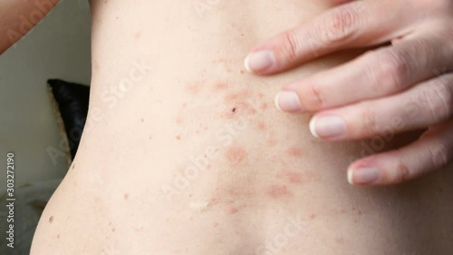 skin rash treatment on woman body. Shingles, Disease, Herpes zoster, varicella-z, lichenoid dermatitis