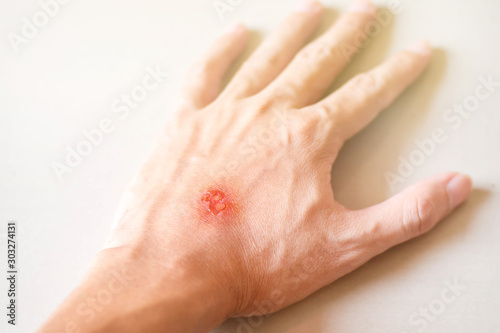 Billede på lærred scab on back left hand