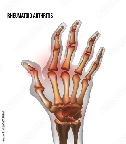 Rheumatoid arthritis image sore inflammation joints of bones the of hand.