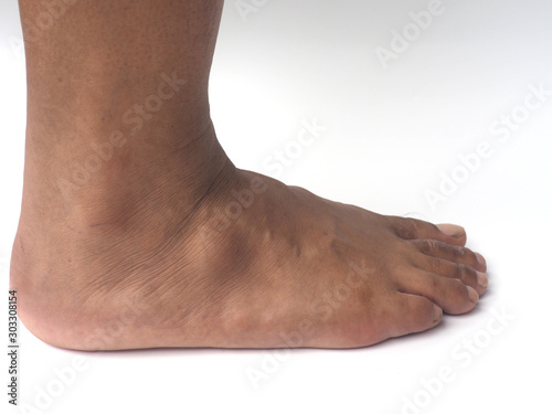 Big ganglion cysts,a sac of jellylike fluid,is on the right foot of man put on the white background.