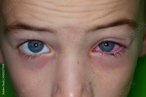 Conjunctivitis is a viral bacterial infection in the eye of a boy.