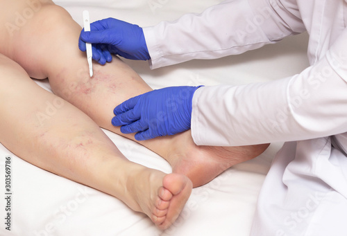 Doctor vascular surgeon holds a scalpel near the legs of a woman with a disease of varicose veins of the lower extremities. The concept of treating varicose veins with surgery © HENADZY