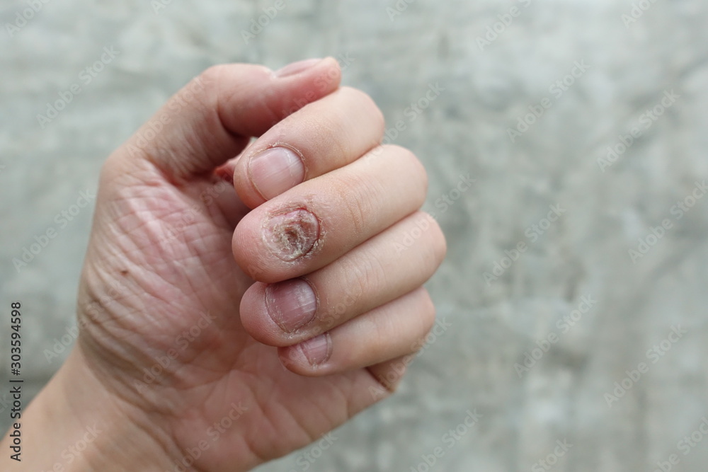 Nail Fungus – West Houston Dermatology