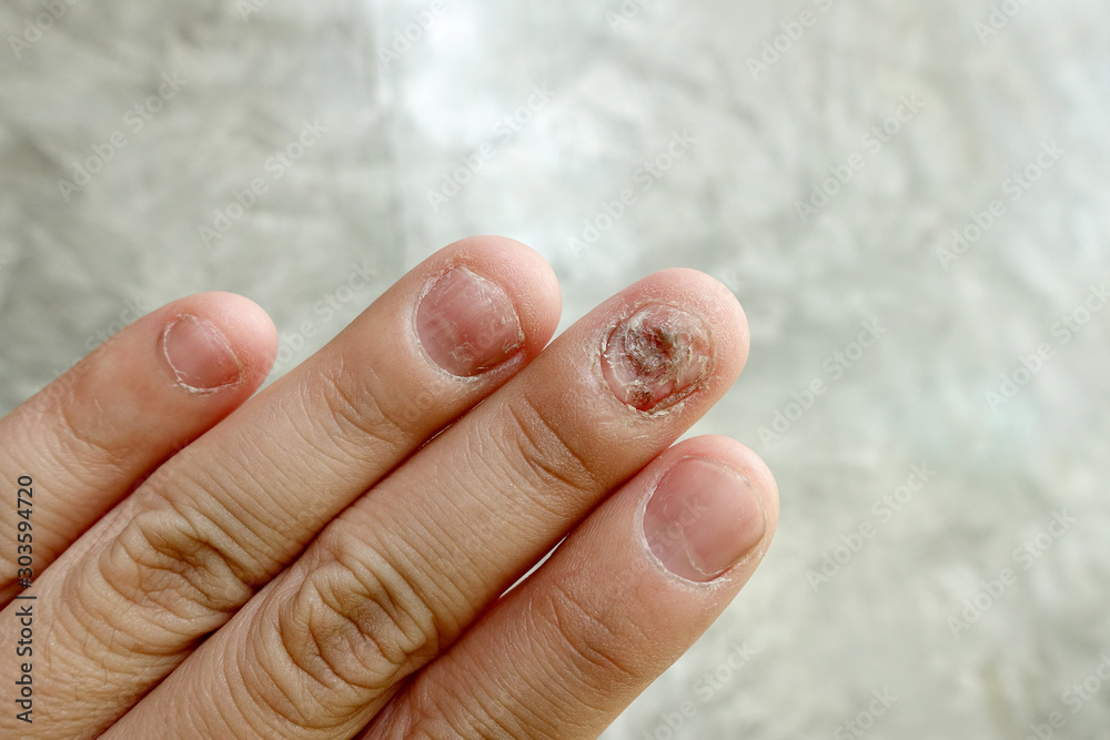View of hand with fungal nail infection (tinea) - Stock Image - M270/0106 -  Science Photo Library