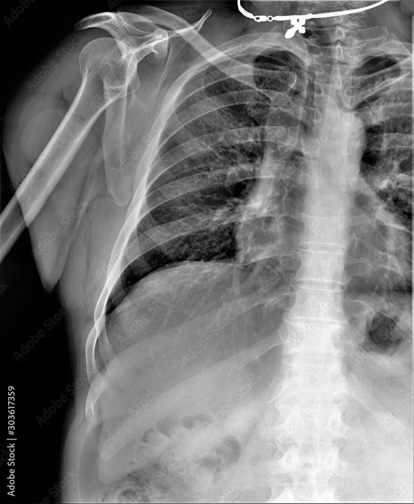 normal radiography of chest organs in direct projection, Traumatology ...