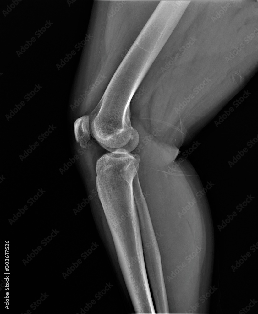 normal radiography of the knee joint in lateral projection, medical diagnostics, traumatology and orthopedics normal radiography of the knee joint in lateral projection, medical diagnostics, traumatology and orthopedics