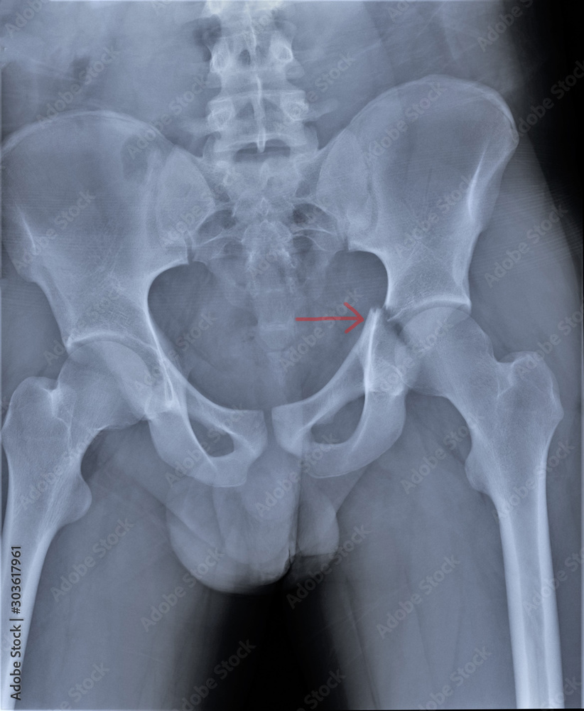 Φωτογραφία radiography of the spine, pelvis with a fracture of the sciatic bone medical dia