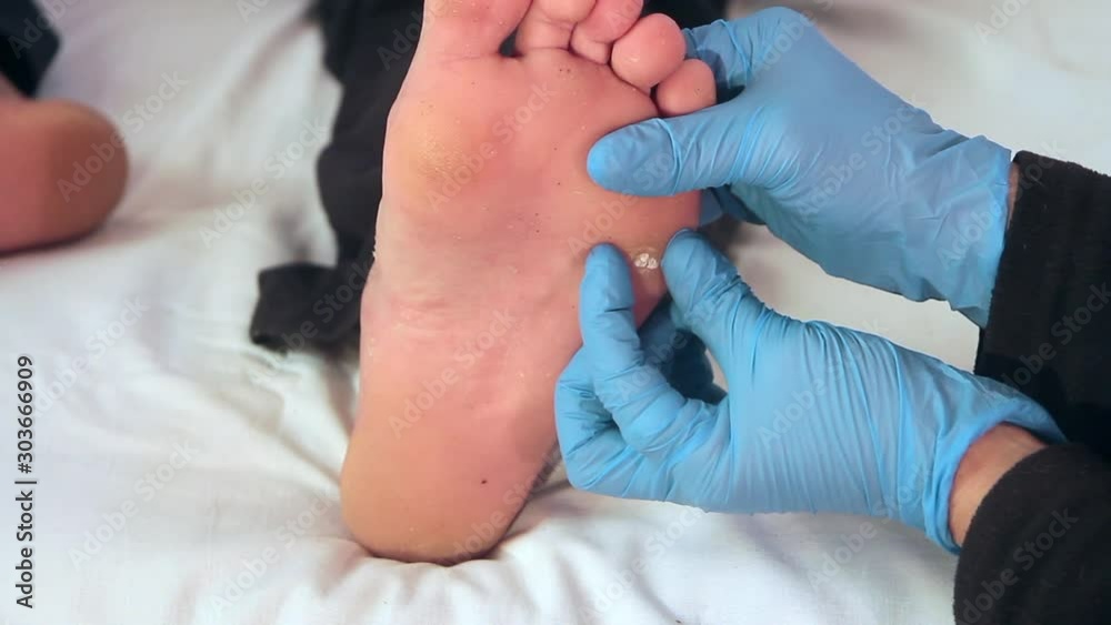 examination of a wart on a right foot by a doctor with blue gloves and