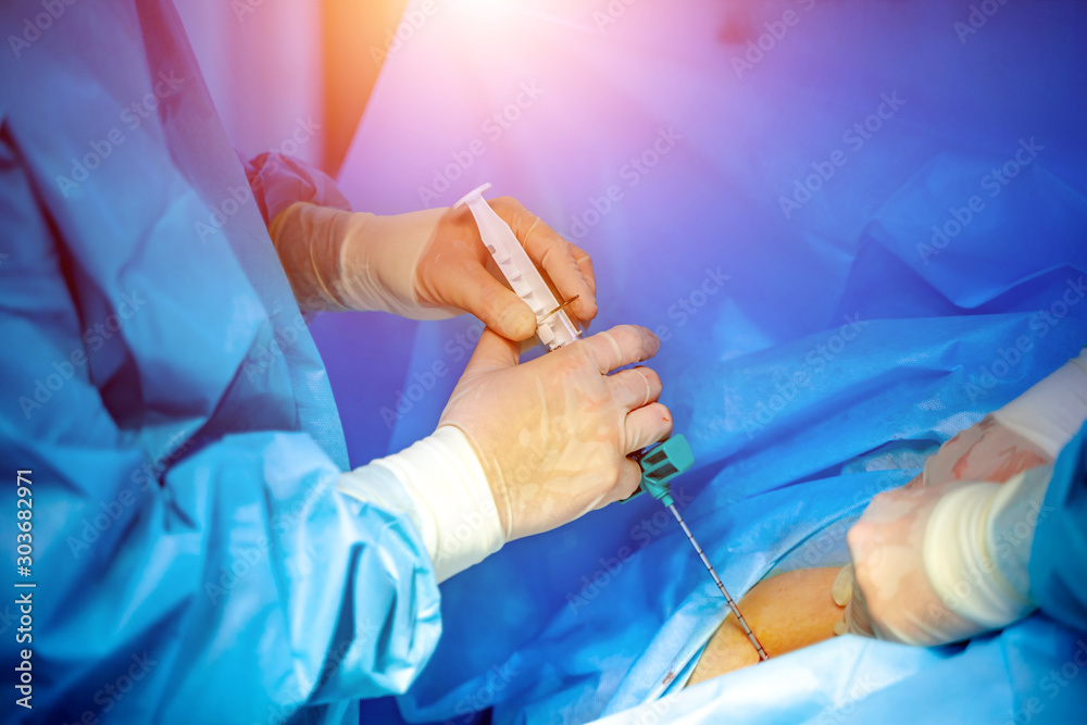 Stem cells operation. Health care concept. Surgeons team working. Bone marrow transplant operation. Plasma in syringe.