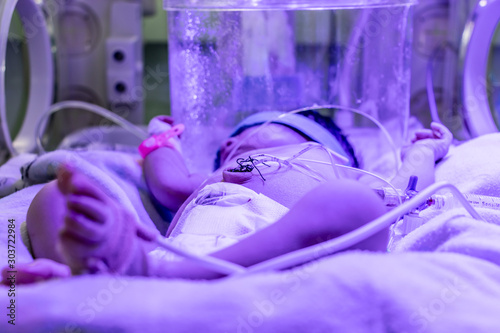 Sick baby under phototherapy light for jaundice, with oxygen in a cephalic hood inside an incubator at the Neonatal intensive care unit