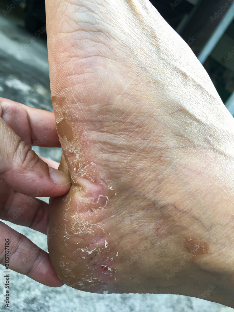 Φωτογραφία Senior woman's heel break and peeling, Dermatitis of feet, Close up and macro sh