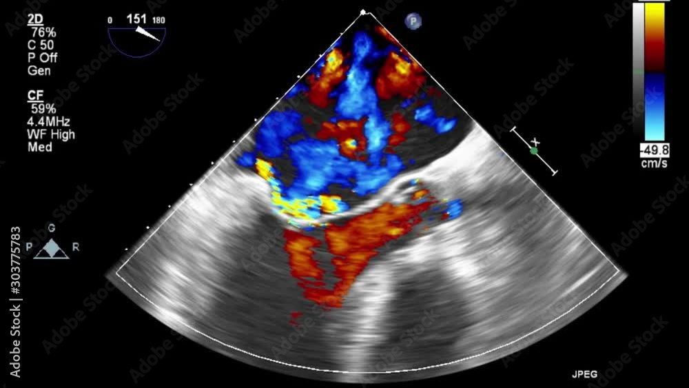 High-quality video ultrasound transesophageal examination of the heart.