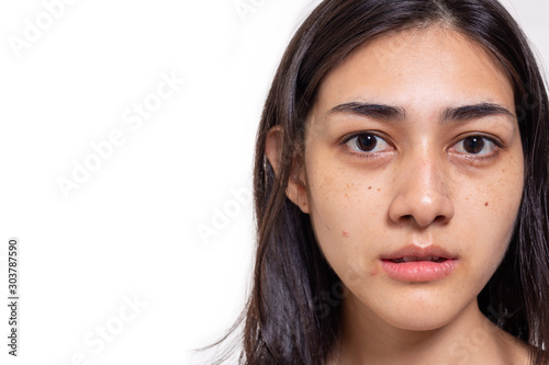 Foto Asian woman gets freckles, blemish, pimple and dull skin on her face