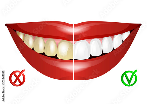 Teeth before and after whitening. Whitening teeth. Vector illustration.