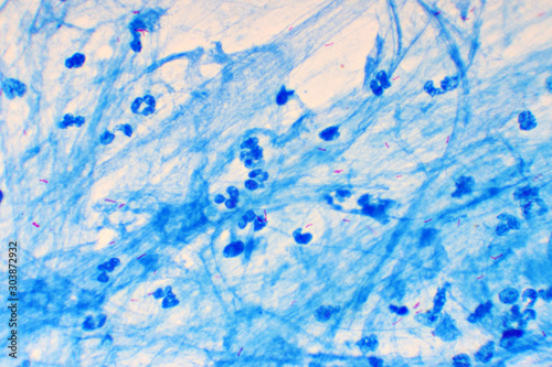 Obraz na płótnie Mycobacterium tuberculosis positive (small red rod) in sputum smear, acid-fast stain, analyze by microscope w salonie