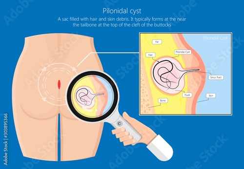Pilonidal cyst nest of hair causes from excessive prolonged sitting diagnose and treatment