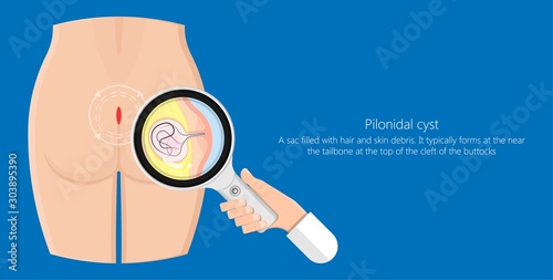 Pilonidal cyst nest of hair causes from excessive prolonged sitting diagnose and treatment