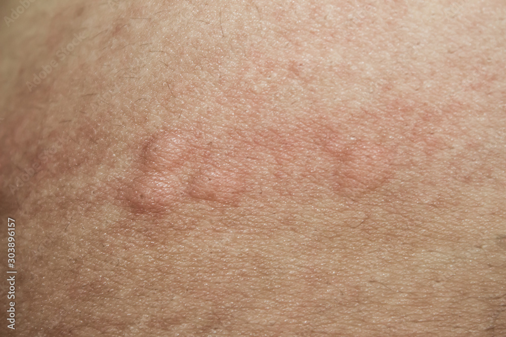 urticaria on skin. rashes, of which urticaria and toxic erythema are the most common.