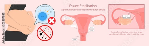 Tubal ligation surgery permanent birth control blocked prevent egg ovary tie uterine banded cauterized sterilizes block