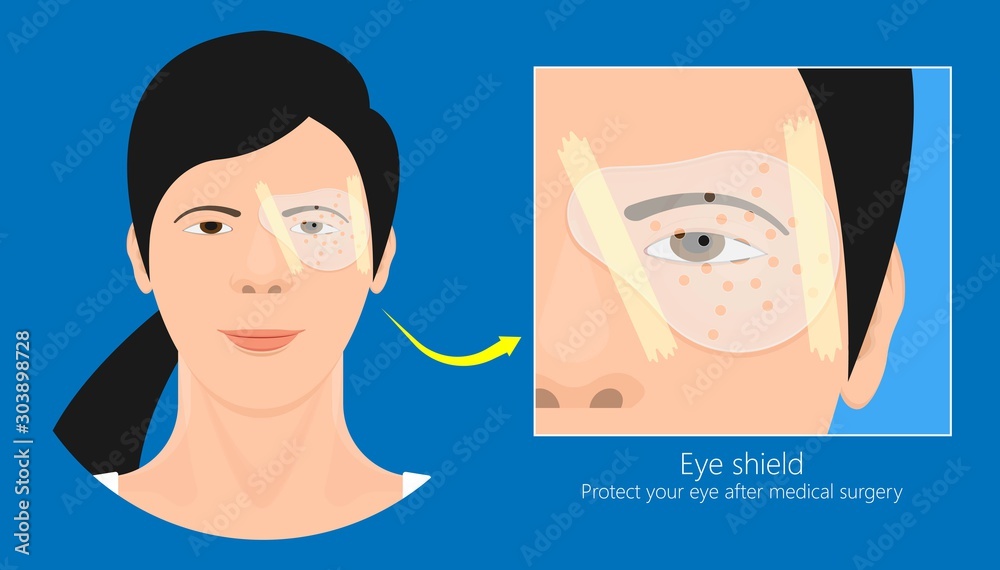 Fotografie cataract surgery eye shield lasik operation corneal transplant Vitrectomy Trabec