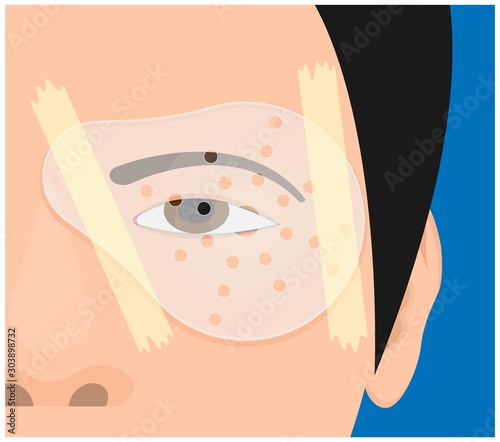 cataract surgery eye shield lasik operation corneal transplant Vitrectomy Trabeculectomy wearing protective