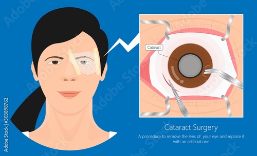 cataract surgery eye shield lasik operation corneal transplant Vitrectomy  Trabeculectomy wearing protective Stock Vector | Adobe Stock