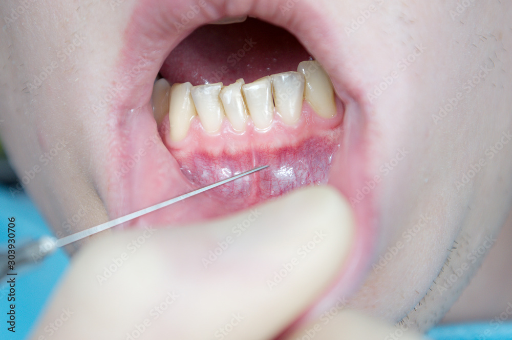 dental anesthesia in the dentist's chair, needle of dental syringe