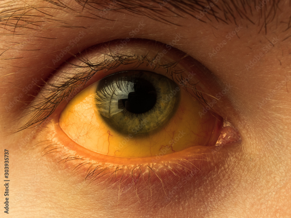yellow staining of the sclera of the eye in diseases of the liver