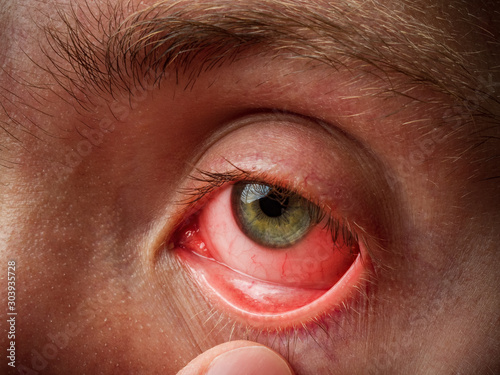 conjunctivitis, conjunctival inflammation, red eyes, infection and inflammation, close up eye photo