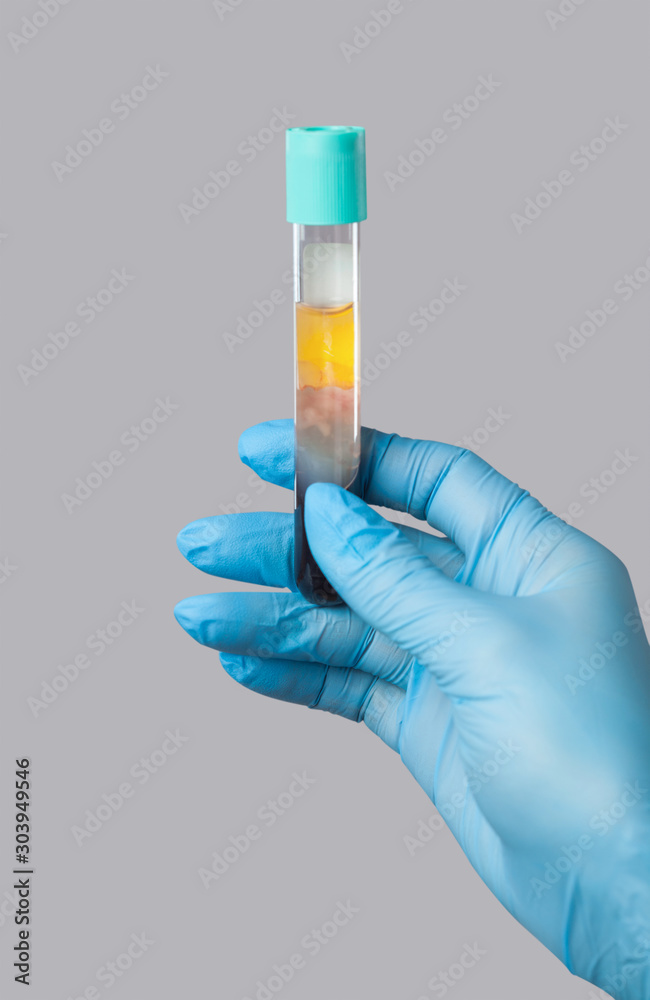 Cosmetologist does prp therapy on the face of a beautiful woman in a beauty salon. There is in vitro blood plasma, ready for injection. Cosmetology concept. Cosmetologist does prp therapy on the face of a beautiful woman in a beauty salon. There is in vitro blood plasma, ready for injection. Cosmetology concept.