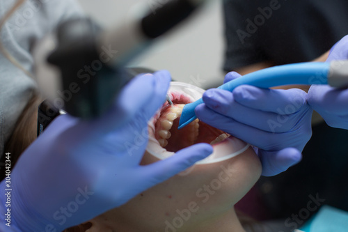 The process of cleaning teeth from Tartar and plaque