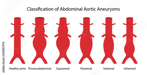 Classification of Abdominal Aortic Aneurysms. Healthy abdominal aorta and abdominal aorta with various types of aneurysm. Vector illustration in flat style isolated on white background