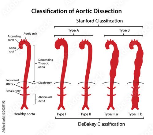 Classification of aortic dissection: Stanford, DeBakey. Healthy aorta with main parts labeled and aorta with various types of dissection. Vector illustration in flat style isolated on white background