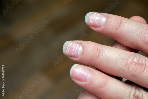 vitamin deficiency avitaminosis anemia nail problem with white dots © vitalis83