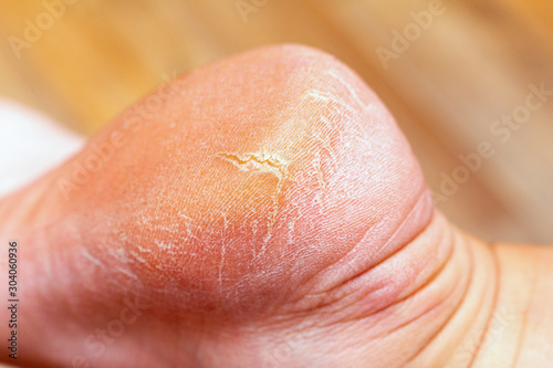 Corn callus cracks on a sole heel foot close up. Dry skin dermatology problem.