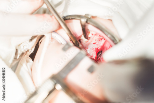 hands of a dentist doctor, closeup. The operation to eliminate the defect of the cleft palate, pathology of the hard palate. The child's mouth is open by the conservative, a bloody wound, gaping.